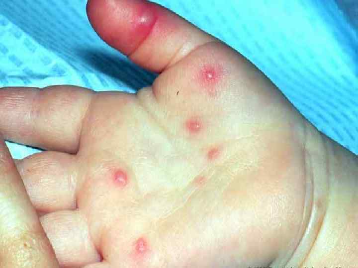 Синдром : рука, стопа, рот. 