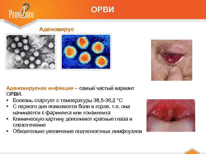 ОРВИ Аденовирусная инфекция – самый частый вариант ОРВИ. • Болезнь стартует с температуры 38,