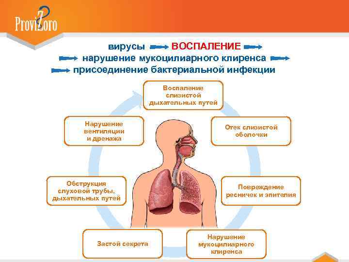 вирусы ВОСПАЛЕНИЕ нарушение мукоцилиарного клиренса присоединение бактериальной инфекции Воспаление слизистой дыхательных путей Нарушение вентиляции