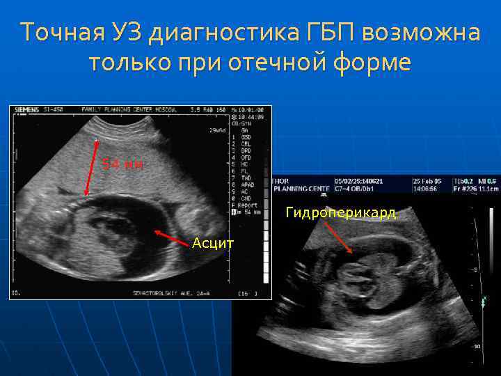 Точная УЗ диагностика ГБП возможна только при отечной форме 54 мм Гидроперикард Асцит 