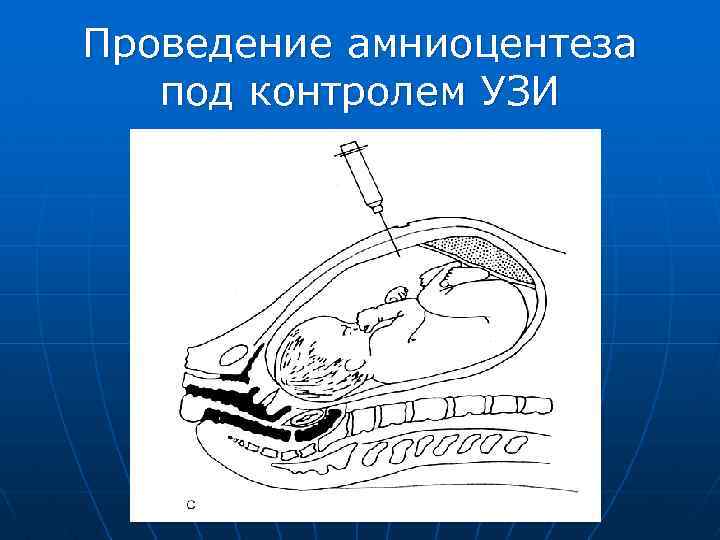 Проведение амниоцентеза под контролем УЗИ 