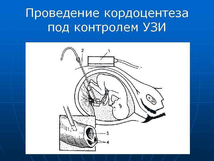 Проведение кордоцентеза под контролем УЗИ 