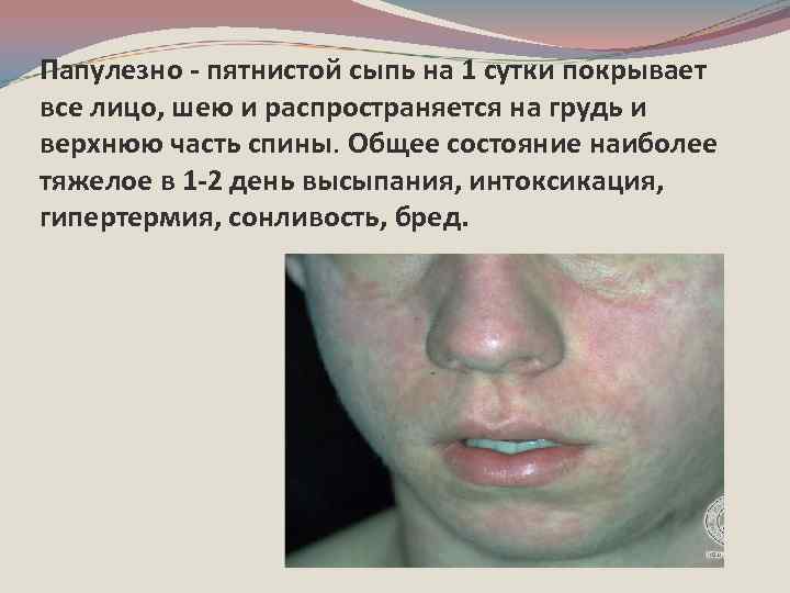 Папулезно - пятнистой сыпь на 1 сутки покрывает все лицо, шею и распространяется на