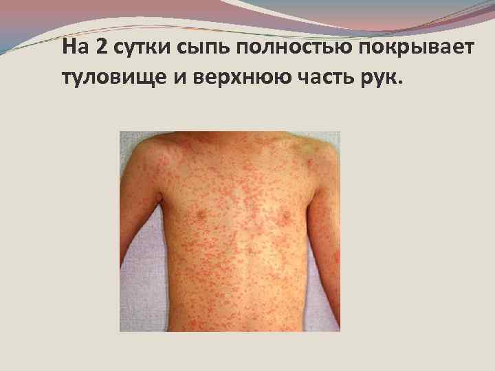 На 2 сутки сыпь полностью покрывает туловище и верхнюю часть рук. 