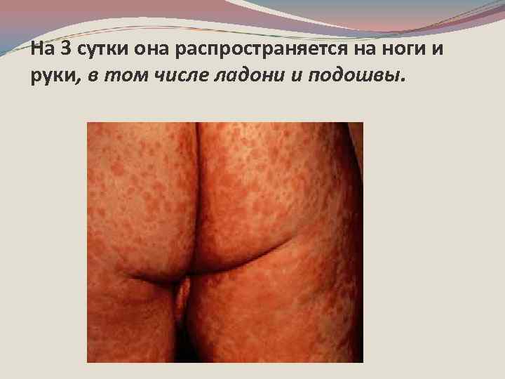 На 3 сутки она распространяется на ноги и руки, в том числе ладони и