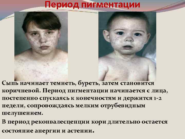 Период пигментации Сыпь начинает темнеть, буреть, затем становится коричневой. Период пигментации начинается с лица,