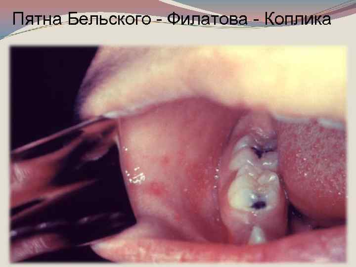 Пятна Бельского - Филатова - Коплика 