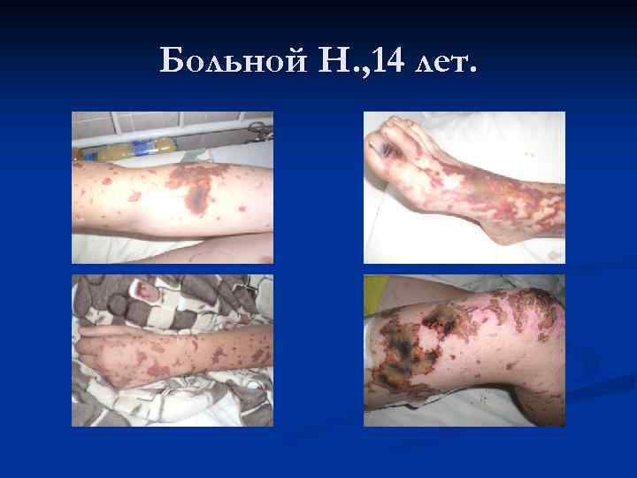 Больной Н. , 14 лет. 
