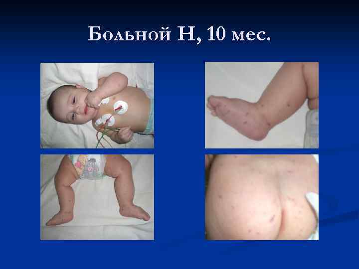 Больной Н, 10 мес. 