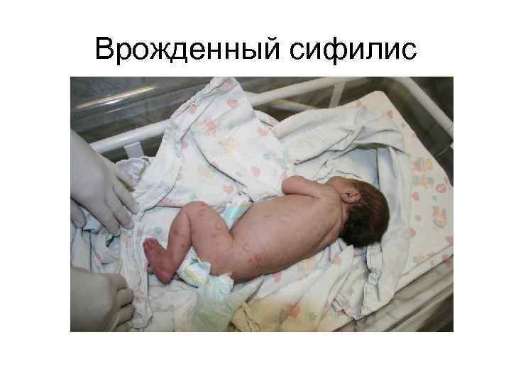 Врожденный сифилис 