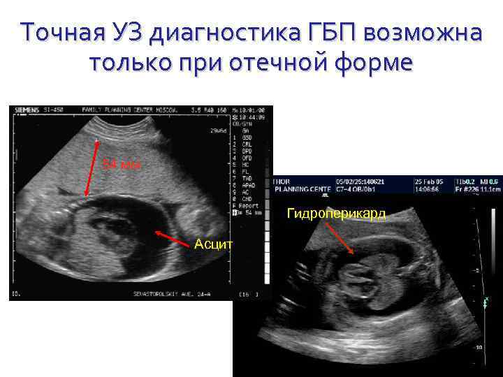 Узи точно. Диагностика ГБП. Гидроперикард УЗИ объем. УЗИ диагностика ГБП.