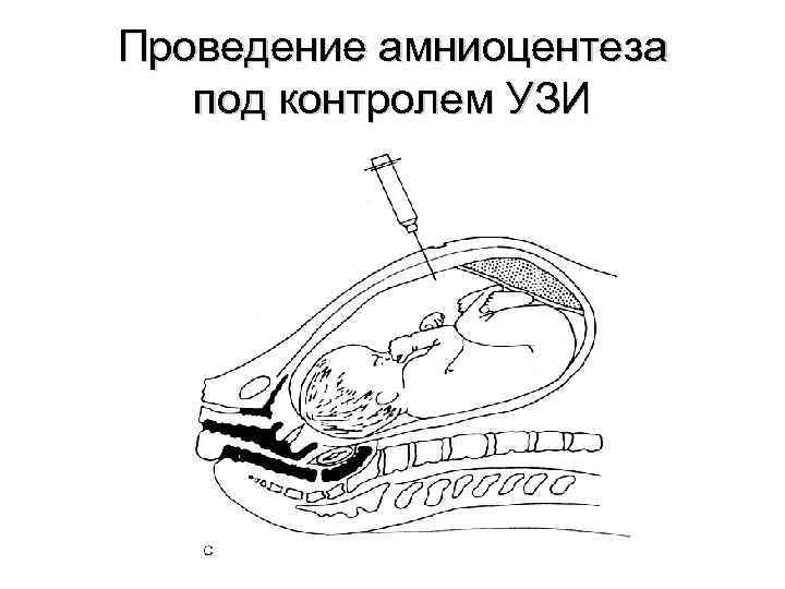 Проведение амниоцентеза под контролем УЗИ 