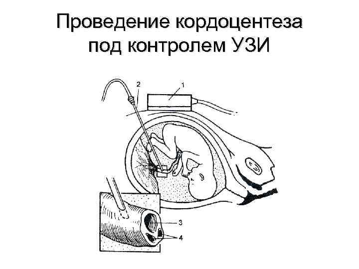 Проведение кордоцентеза под контролем УЗИ 