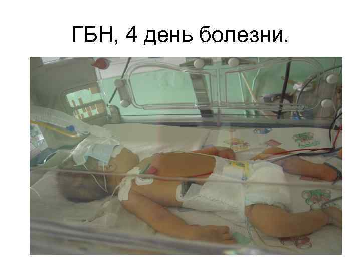 ГБН, 4 день болезни. 