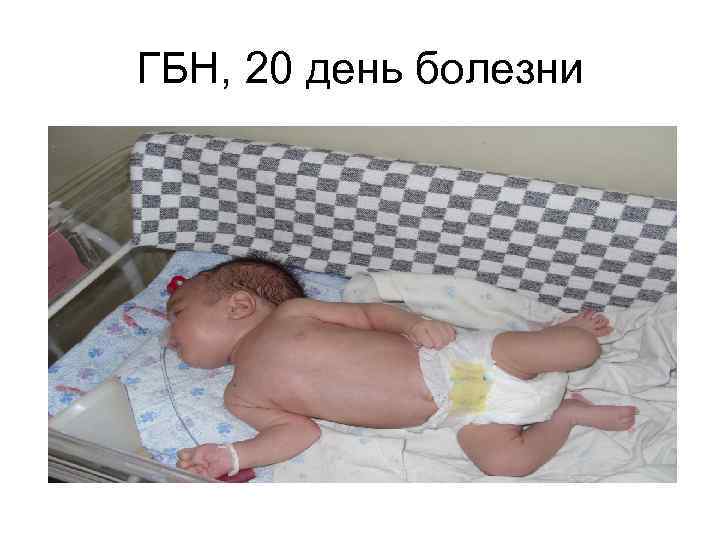 ГБН, 20 день болезни 