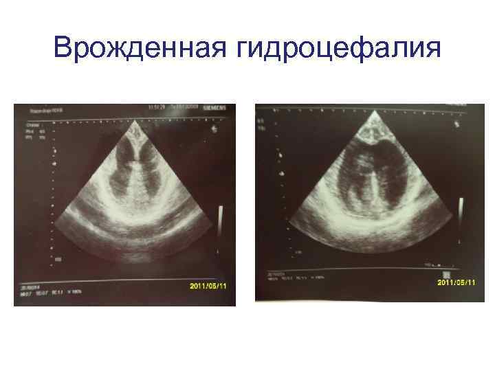 Врожденная гидроцефалия 