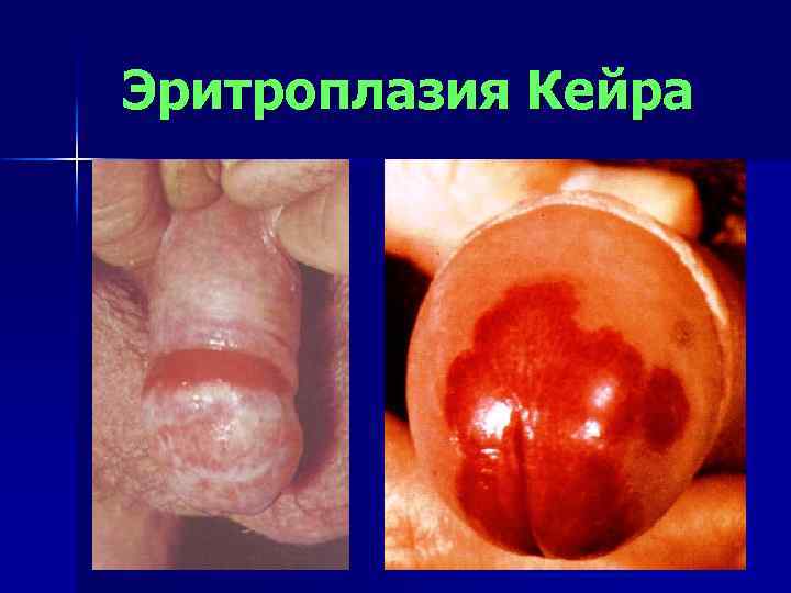 Эритроплазия Кейра 