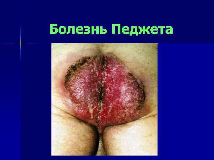 Болезнь Педжета 