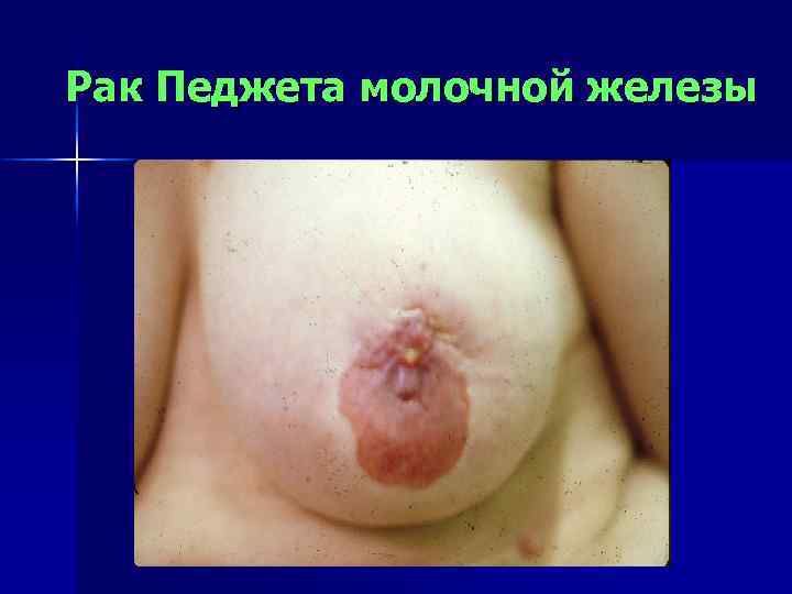 Рак Педжета молочной железы 