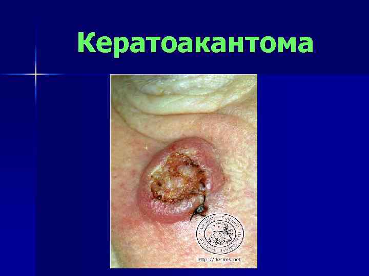Кератоакантома 