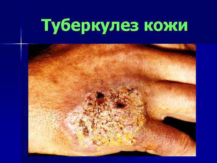 Туберкулез кожи 