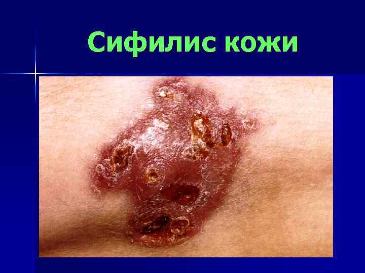 Сифилис кожи 
