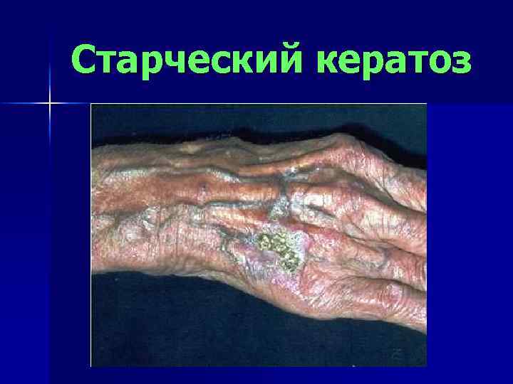 Старческий кератоз 