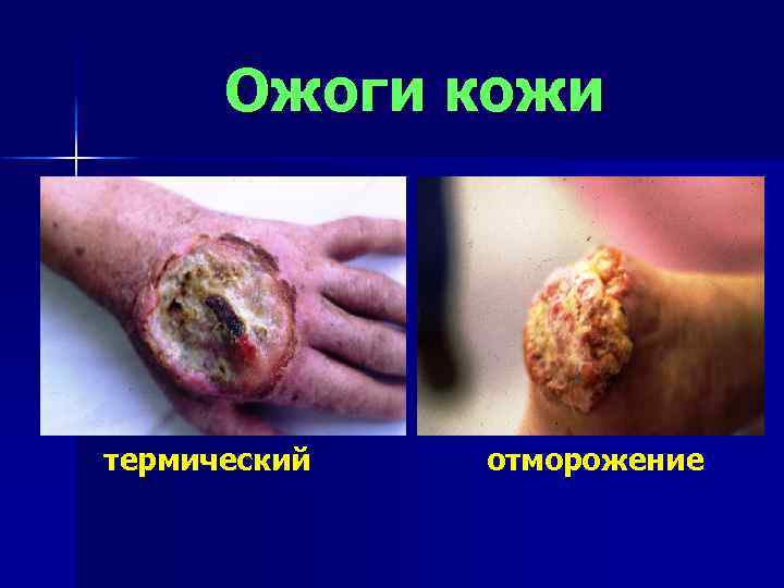 Ожоги кожи термический отморожение 