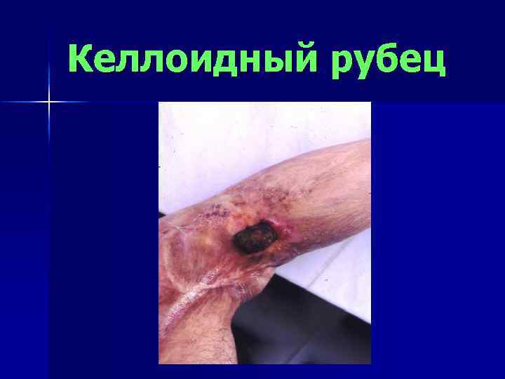 Келлоидный рубец 