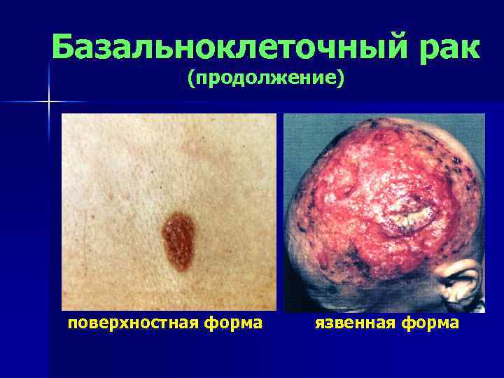 Базальноклеточный рак (продолжение) поверхностная форма язвенная форма 