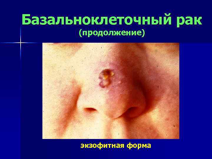 Базальноклеточный рак (продолжение) экзофитная форма 