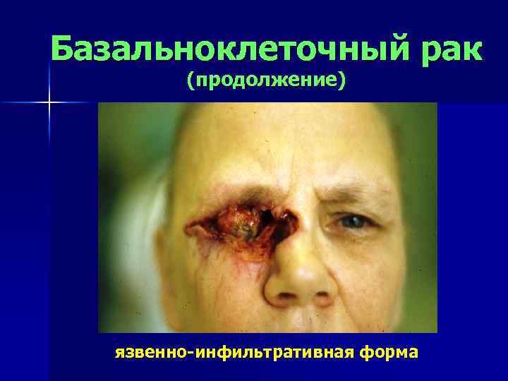 Базальноклеточный рак (продолжение) язвенно-инфильтративная форма 