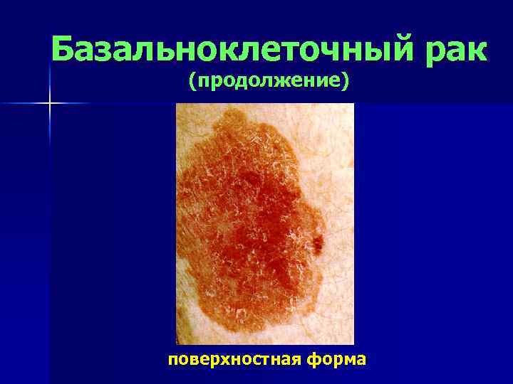 Базальноклеточный рак (продолжение) поверхностная форма 