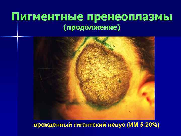 Пигментные пренеоплазмы (продолжение) врожденный гигантский невус (ИМ 5 -20%) 