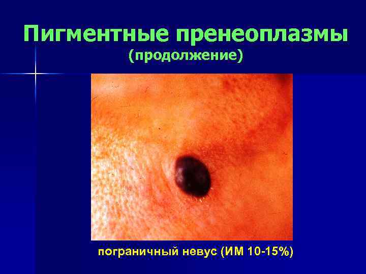 Пигментные пренеоплазмы (продолжение) пограничный невус (ИМ 10 -15%) 