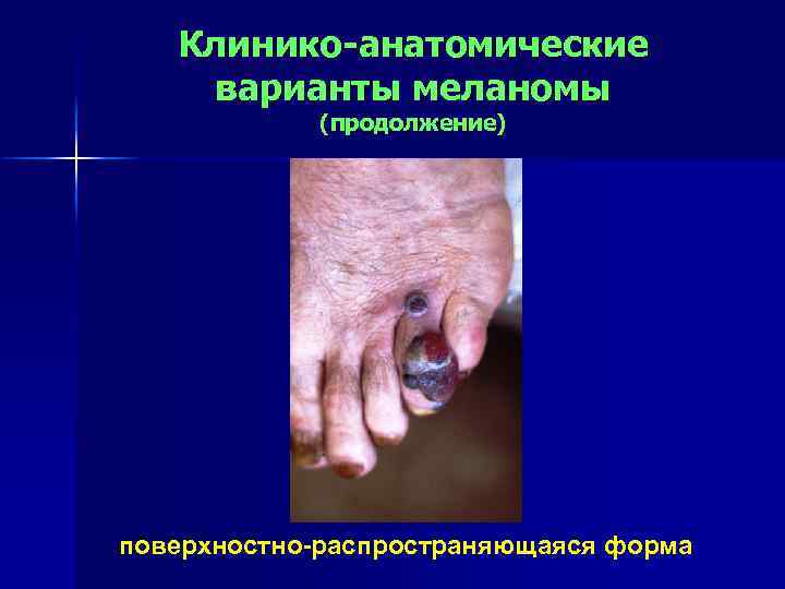 Клинико-анатомические варианты меланомы (продолжение) поверхностно-распространяющаяся форма 