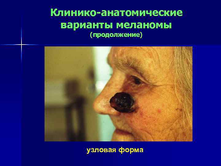 Клинико-анатомические варианты меланомы (продолжение) узловая форма 