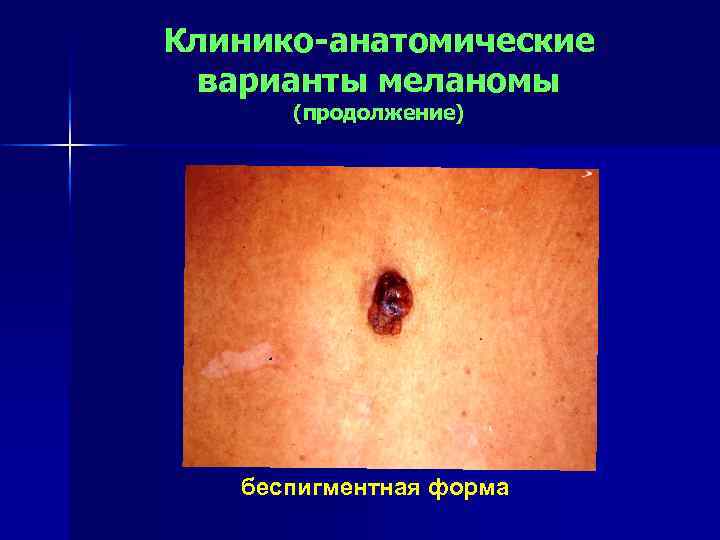 Клинико-анатомические варианты меланомы (продолжение) беспигментная форма 