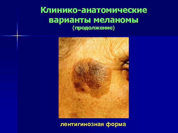 Клинико-анатомические варианты меланомы (продолжение) лентигинозная форма 