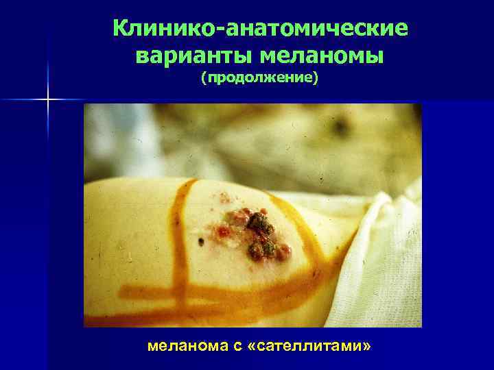 Клинико-анатомические варианты меланомы (продолжение) меланома с «сателлитами» 