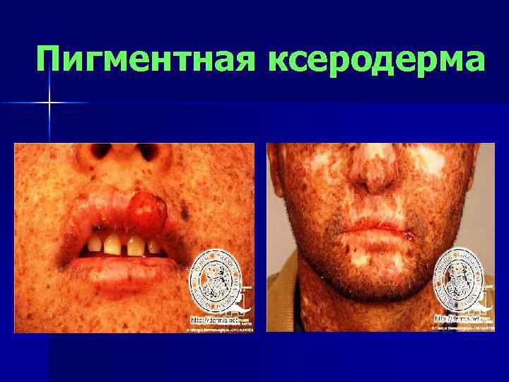 Пигментная ксеродерма 