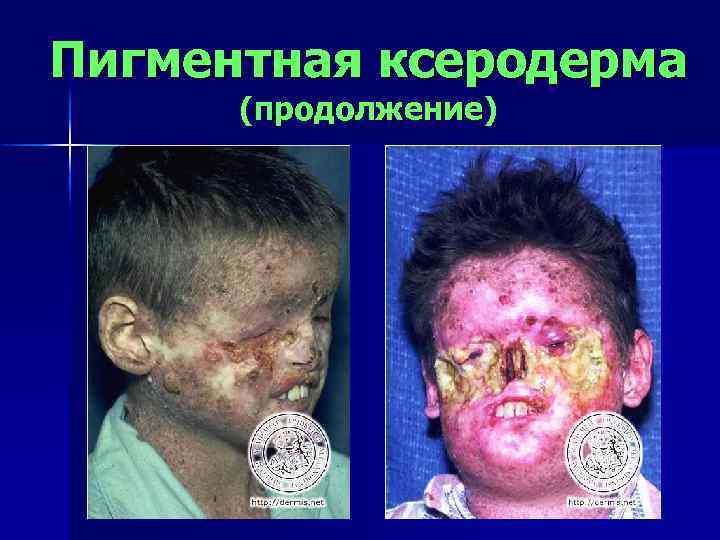 Пигментная ксеродерма (продолжение) 