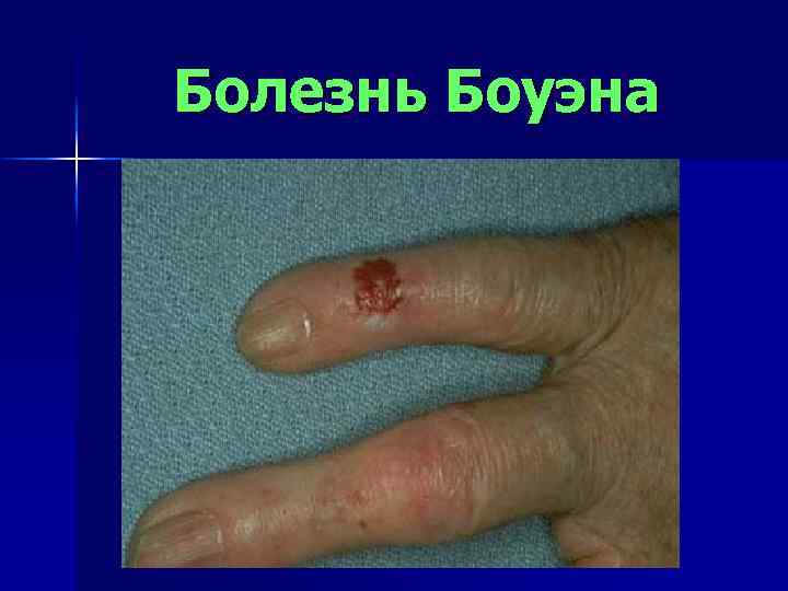 Болезнь Боуэна 