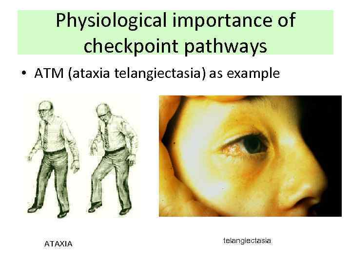 Physiological importance of checkpoint pathways • ATM (ataxia telangiectasia) as example ATAXIA telangiectasia 