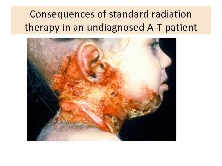 Consequences of standard radiation therapy in an undiagnosed A-T patient 