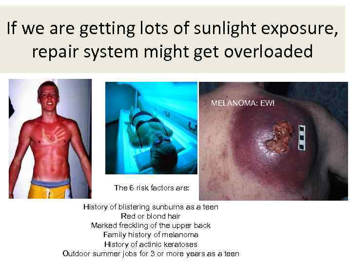 If we are getting lots of sunlight exposure, repair system might get overloaded MELANOMA: