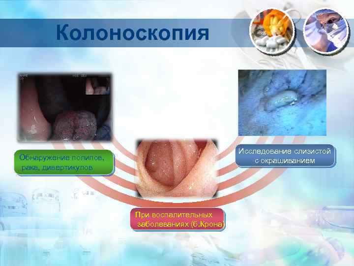 Колоноскопия Исследование слизистой с окрашиванием Обнаружение полипов, рака, дивертикулов При воспалительных заболеваниях (б. Крона)