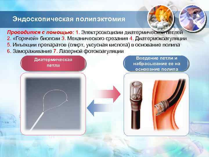 Эндоскопическая полипэктомия Проводится с помощью: 1. Электроэксцизии диатермической петлей 2. «Горячей» биопсии 3. Механического