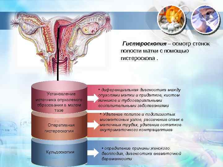  Гистероскопия – осмотр стенок полости матки с помощью гистероскопа. Установление источника опухолевого образования