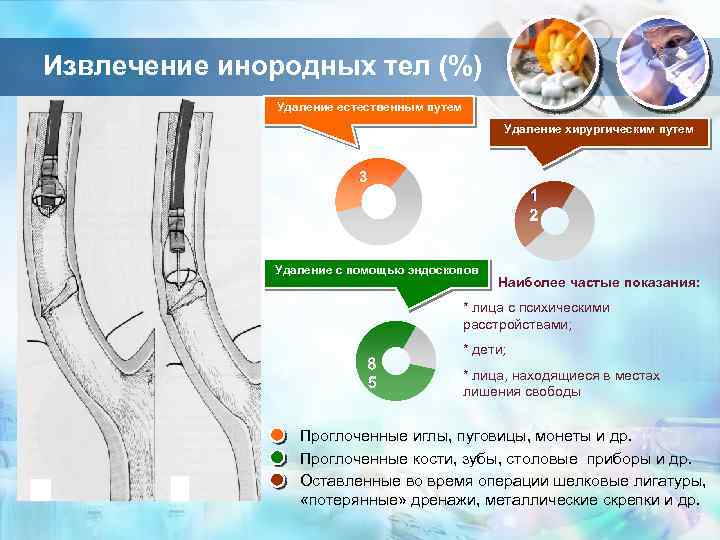 Извлечение инородных тел (%) Удаление естественным путем Удаление хирургическим путем Удаление с помощью эндоскопов